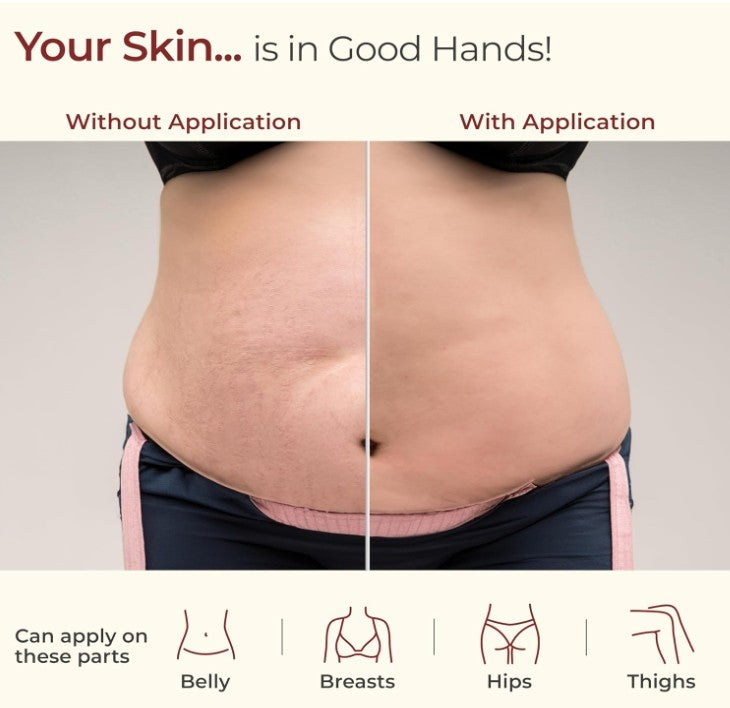 Luvlap Stretch Mark Oil